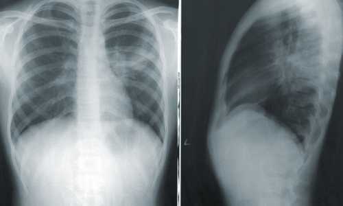 xray Auf einer Röntgenaufnahme, einem CT- oder MRT-Bild sind Verspannungen nicht sichtbar